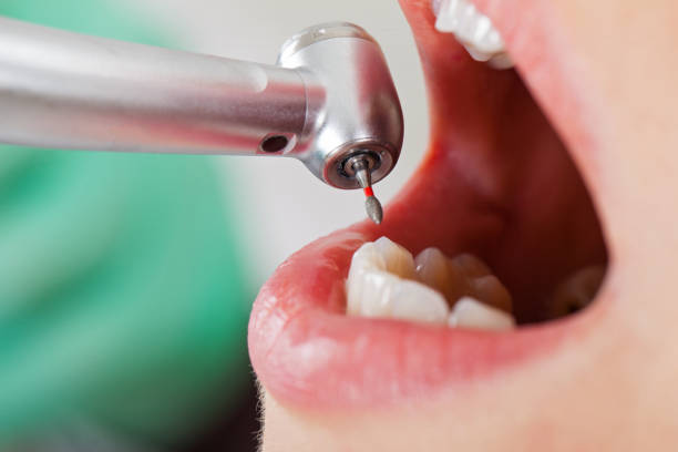 Best Emergency Root Canal Treatment in Carlisle Rockledge, AL